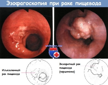 Clinica și diagnosticul cancerului esofagian