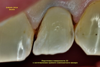 Композитні вініри, реставрація 22 enamel plus hri