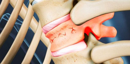 Fractura de compresie a coloanei vertebrale la simptomele copilului, tratament