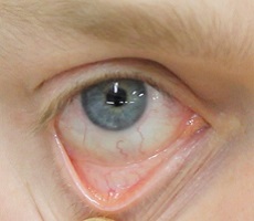 Кон'юнктива (слизова оболонка) очі - будову і функції, діагностика і захворювання - сайт -