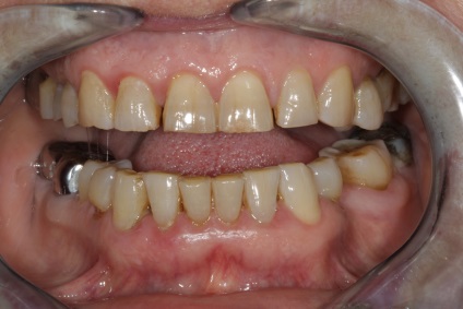 Криві зуби