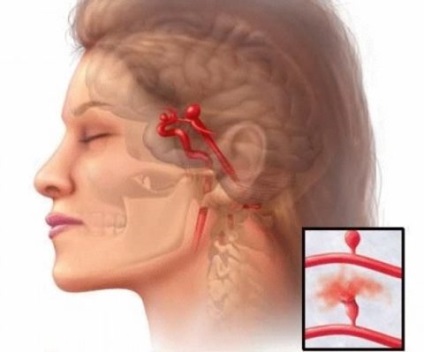 Лікування аневризми судин головного мозку методи боротьби із захворюванням, uflebologa