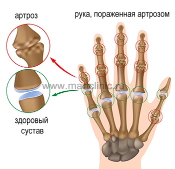 Tratamentul artritei (osteoartritei) din Sankt Petersburg