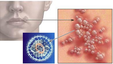 Tratamentul herpesului cu ajutorul unui factor de transfer, infecția cu herpesvirus, tratamentul herpesului cronic