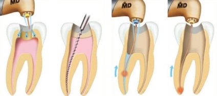 Tratamentul canalelor canalelor, stomatologia terapeutică la Moscova, servicii de curățare a canalului rădăcinii,