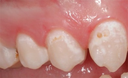 A kezelés a fogszuvasodás leírás okokból népi jogorvoslat, a megelőző