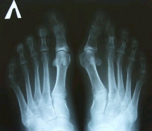 Лікування кісточки або шишки великого пальця на нозі без операції