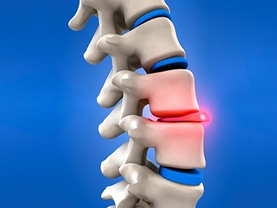 Лікування міжхребцевої грижі народними засобами