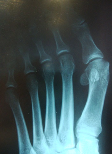 Kezelése dudorok és üregek a lábát, ortopédiai trauma és Petrosyan