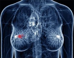 A kezelés a női daganatos emberek jogorvoslatok