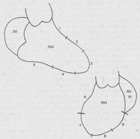 Angiografia ventriculară stângă (ventriculografia) - diagnosticul anginei pectorale - angină pectorală - totul despre