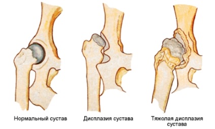 Gyógytorna, fizioterápia, Bubnovskaya testmozgás, jóga coxarthrosis (coxarthrosis) Gyógytorna, fizioterápia, Bubnovskaya testmozgás, jóga coxarthrosis