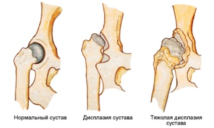 ЛФК, лікувальна гімнастика, вправи Бубновського, йога при коксартрозе