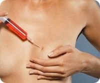 Lipofilling breast (augmentarea sânilor cu grăsime proprie) - ceea ce este, înainte și după fotografii, prețuri, recenzii