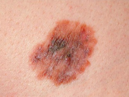 Меланомът (рак на кожата) - най-симптоми, превенция и лечение, здраве книга