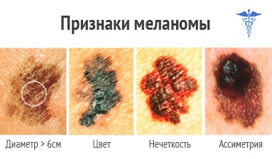 Melanomul (cancer de piele) - simptome, prevenire și tratament, cartea de sănătate