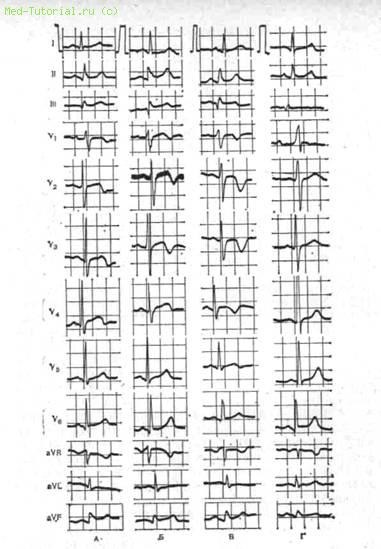 Infarct miocardic cu focal mic