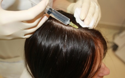 Hair Mezoterápia (mezoterápia) haj Mezoterápia