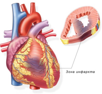 Microinfarction - причини, симптоми, лечение и профилактика