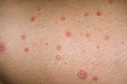 Eczemele asemănătoare cu cele ale cauzei și ale tratamentului