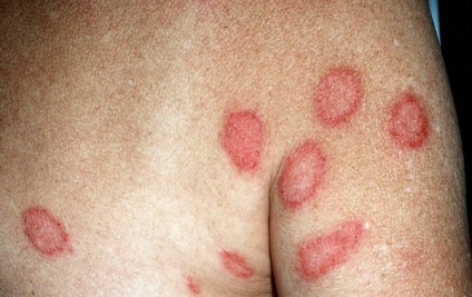 Eczeme asemănătoare cu cele ale cauzei, tratament, fotografie