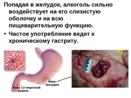 Este posibil sa bei vodca si alte alcool cu ​​un ulcer gastric?