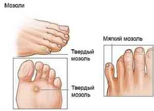 Мозоль водяний лікування - захворювання шкіри - каталог статей - як бути красивою