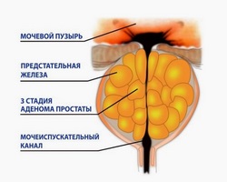 Alocarea uzi-ului prostatic cu determinarea urinei reziduale