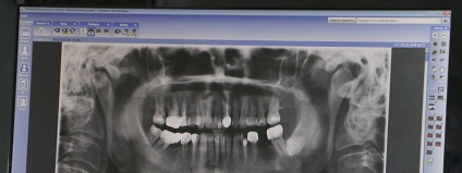 Ortopantomograma o imagine panoramică a dinților pe film, o fotografie panoramică a maxilarului de pe film în