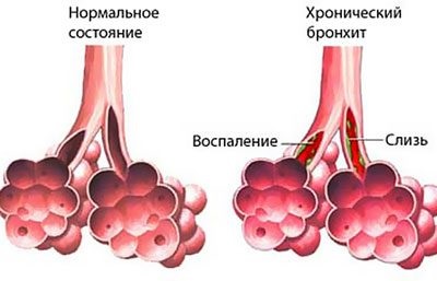 Отруєння і передозування амоксициліну симптоми, лікування