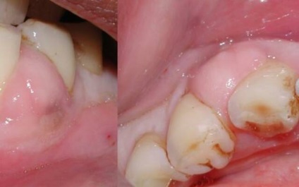 Пародонтальний абсцес фото, симптоми, лікування, причини виникнення
