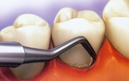 Periodontită - cauze, simptome, tipuri, tratament și prevenire - dinte medic