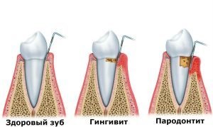 Periodontită - cauze, simptome, tipuri, tratament și prevenire - dinte medic