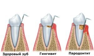 Пародонтит - причини, симптоми, види, лікування і профілактика - доктор зуб
