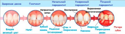 Periodontită - cauze, simptome, tipuri, tratament și prevenire - dinte medic