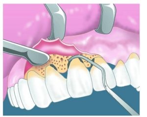 Periodontită - cauze, simptome, tipuri, tratament și prevenire - dinte medic