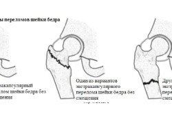 Fractura simptomelor și tratamentului șoldului cervical