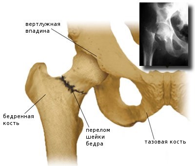 Перелом шийки стегна симптоми і методи лікування