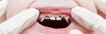 Periodontită a dinților sugarilor în metodele de prevenire și tratament pentru copii