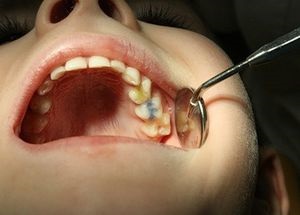 Parodontitisz tejfogainak gyerekek tüneteit, szakaszait paradentózisnál tejfogak