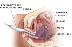 Підготовка до узі малого таза