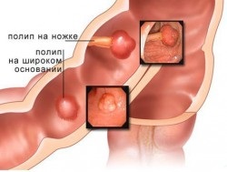 Polipi în simptomele intestinului, tratament cu remedii folclorice