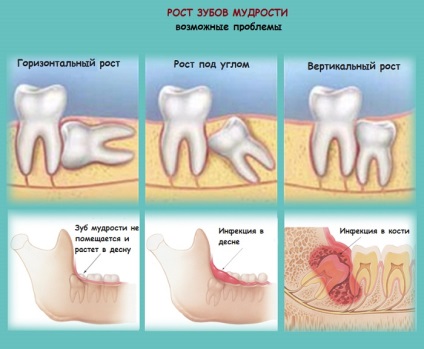 Наслідки видалення зуба мудрості симптоми і лікування