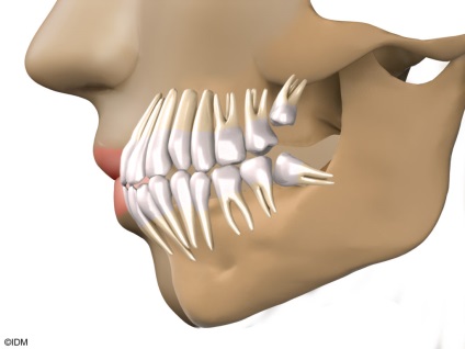 Consecințele înțelepciunii și tratamentului extracției dinților