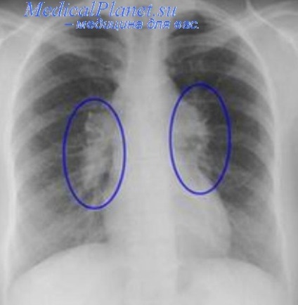 Post Fibroză pulmonară pulmonară