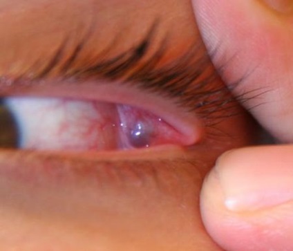 Cauze de durere în frunte și ochi