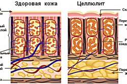 Причини виникнення целюліту