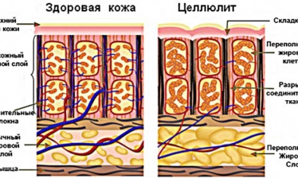 Причини виникнення целюліту