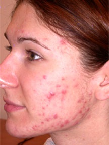 Utilizarea aditivilor biologic activi în tratamentul acneei (acnee), a medicilor despre natură