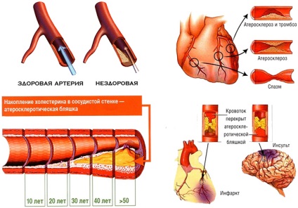 Tünetei angina férfiak és elsősegély